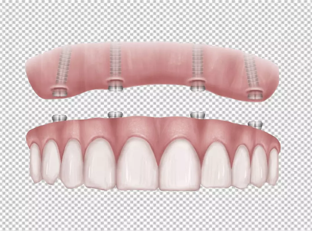Illustration of All-on-4 Dental Implants Supporting a Full Arch Prosthetic Denture