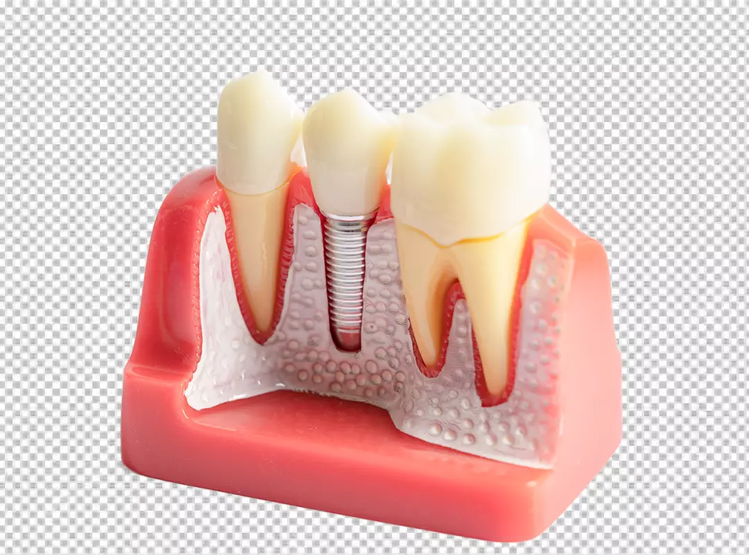 Realistic Dental Implant Model Showing Tooth Replacement and Oral Anatomy