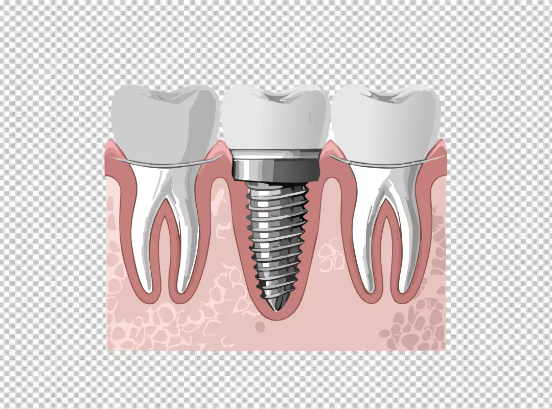 Illustrative Diagram of Modern Dental Implant and Adjacent Healthy Teeth