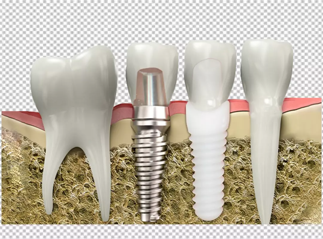 Comparative Anatomy of Natural Teeth and Modern Dental Implants in Jawbone