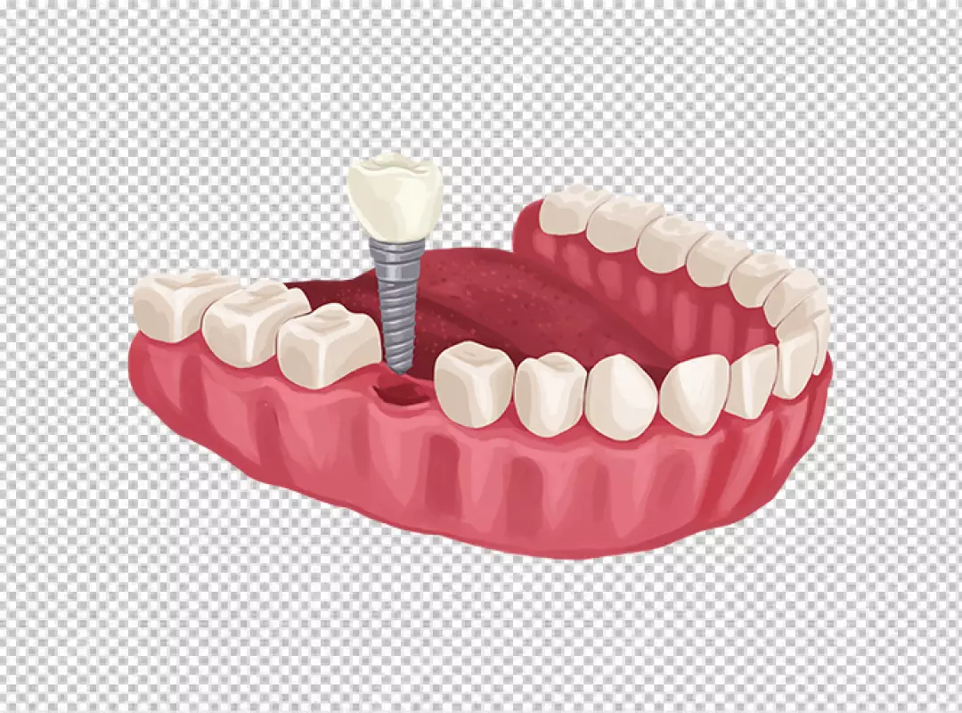 Dental Implant Illustration Showing Tooth Replacement in Jawbone for Oral Health