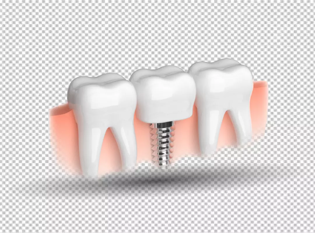Detailed 3D Illustration of Tooth Implant in Gums for Dental Health