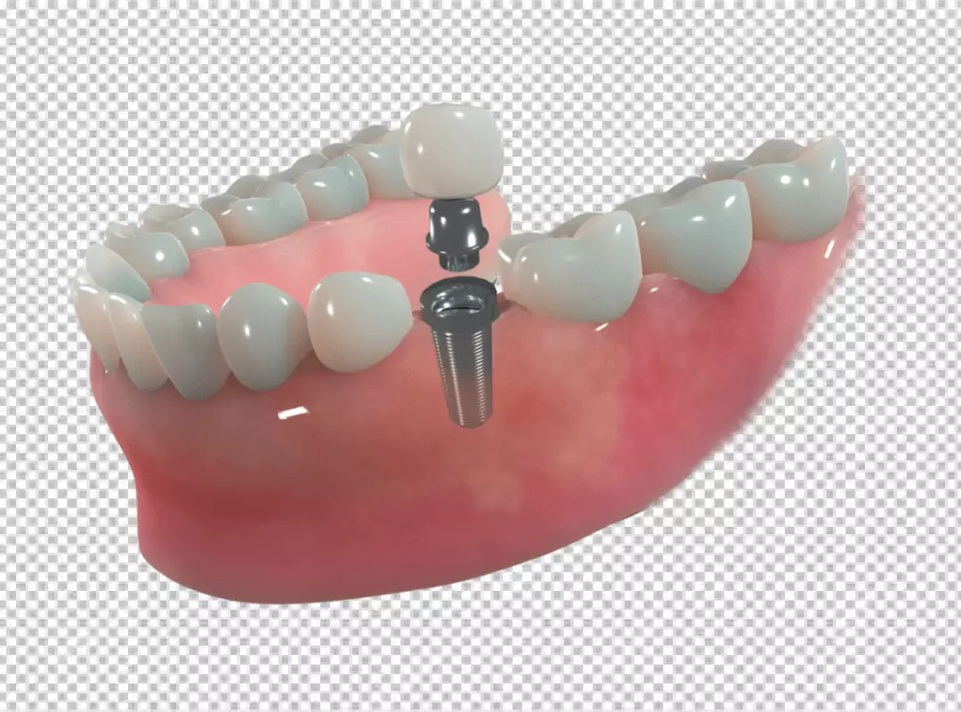 Step-by-Step 3D Dental Implant Components for Advanced Tooth Restoration