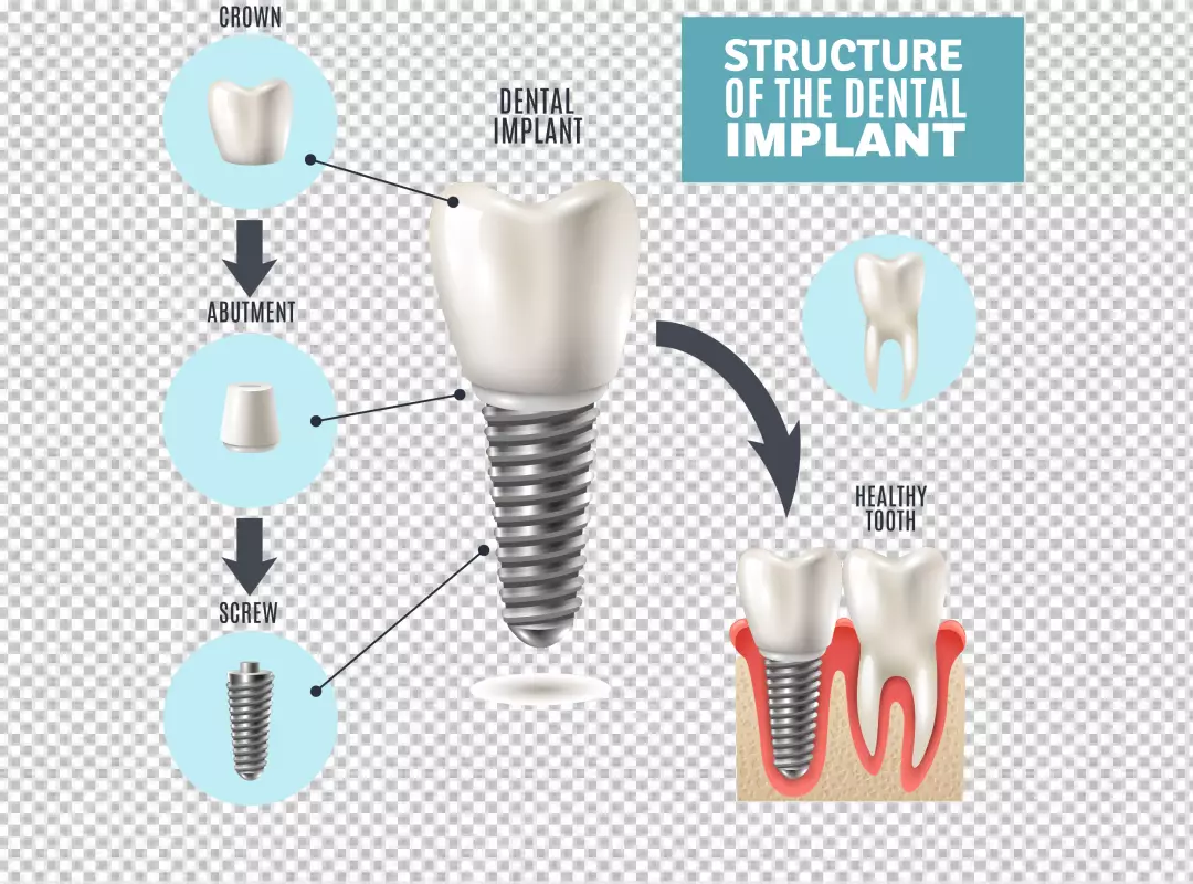 Illustrated Dental Implant Structure and Components for Oral Health Education