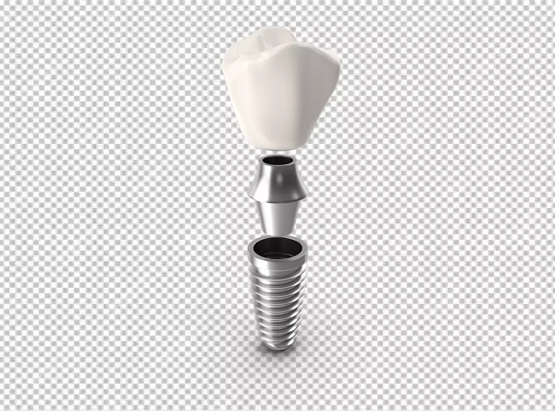 Exploded View 3D Dental Implant Prosthesis Components