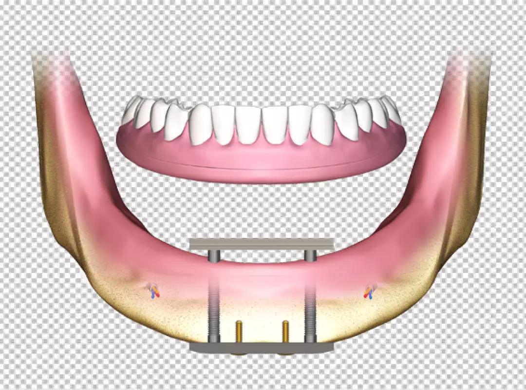 3D Rendering of All-on-4 Dental Implants Supporting a Full Arch Prosthesis