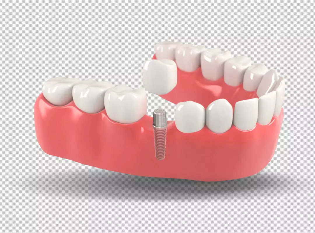3D Model of Dental Implant: Jaw, Abutment, and Crown Components