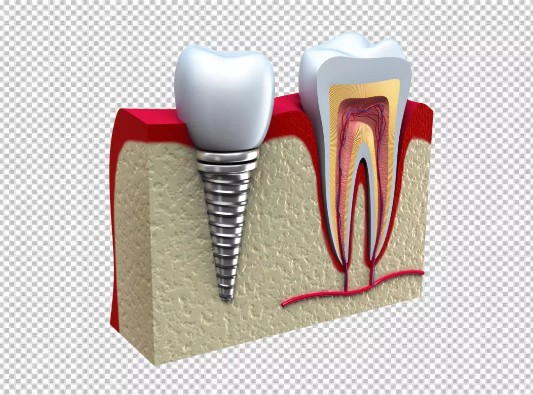 Comparative View of Dental Implant and Human Tooth Anatomy