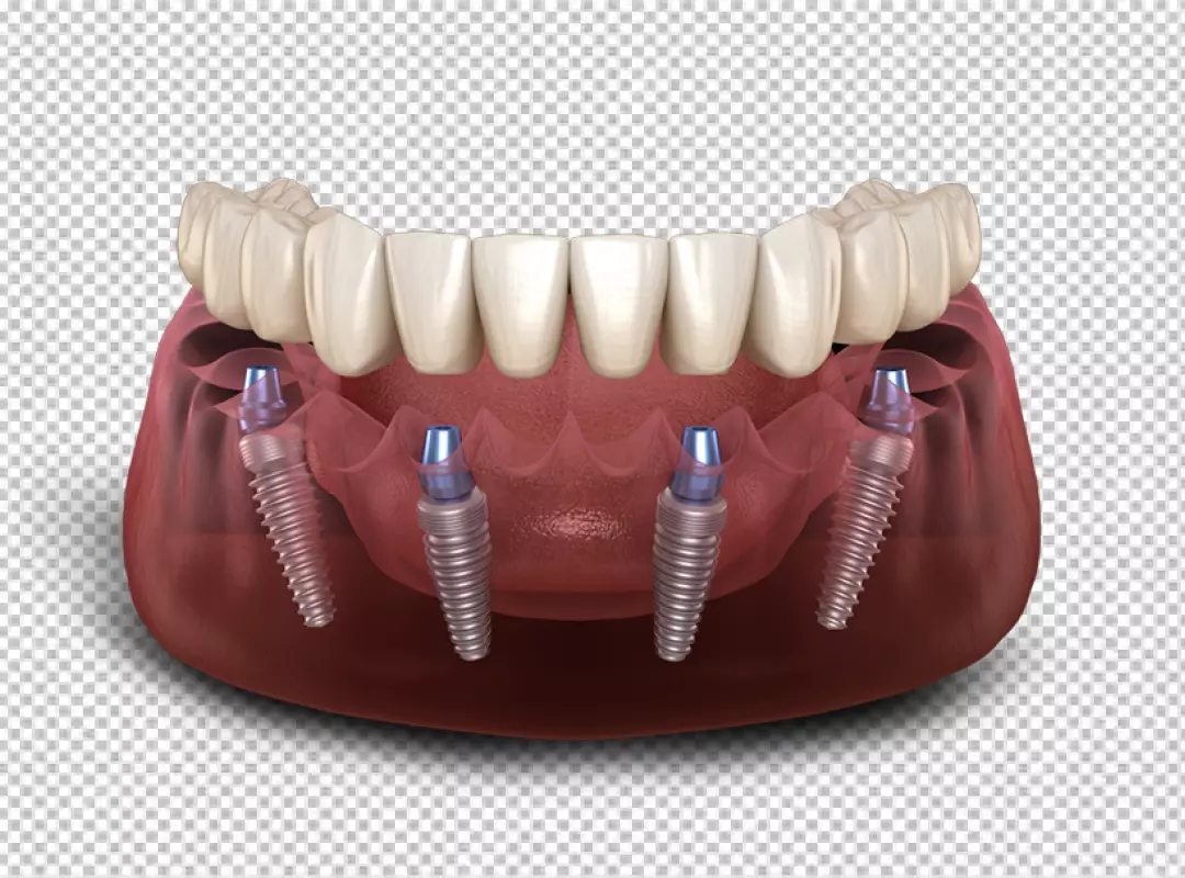 3D Rendering of All-on-4 Dental Implants in Human Lower Jaw