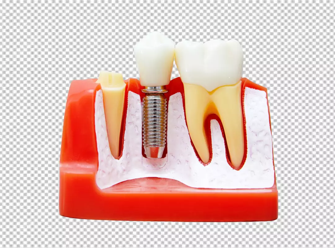 Detailed Dental Implant Model Illustrating Prosthetic Tooth Placement for Oral Health
