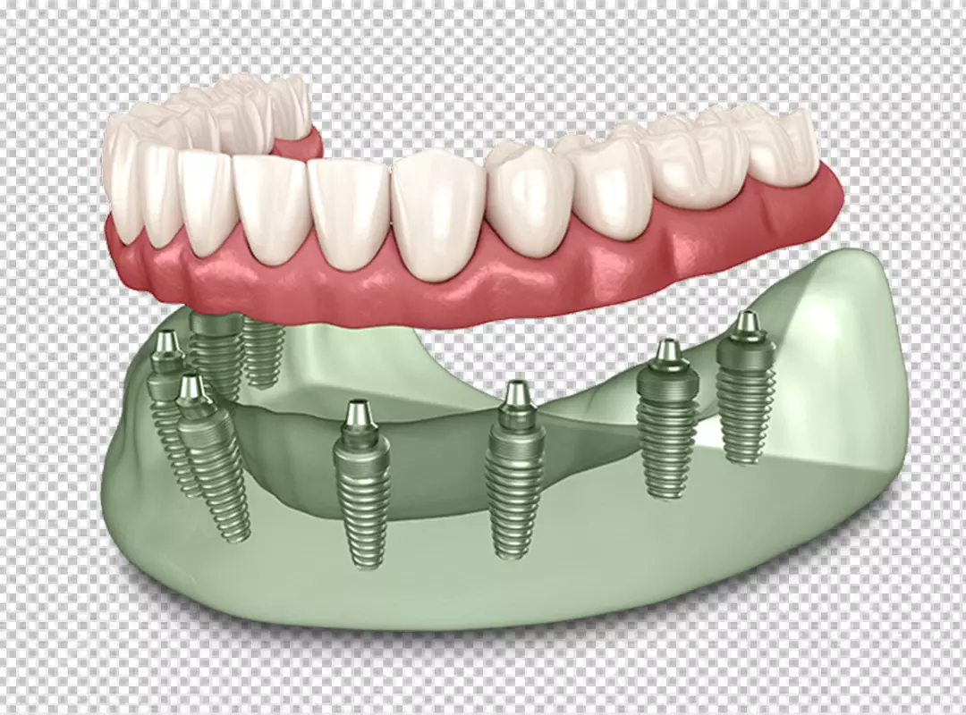 Advanced 3D Dental Model Showing Full Arch Restoration with Implants
