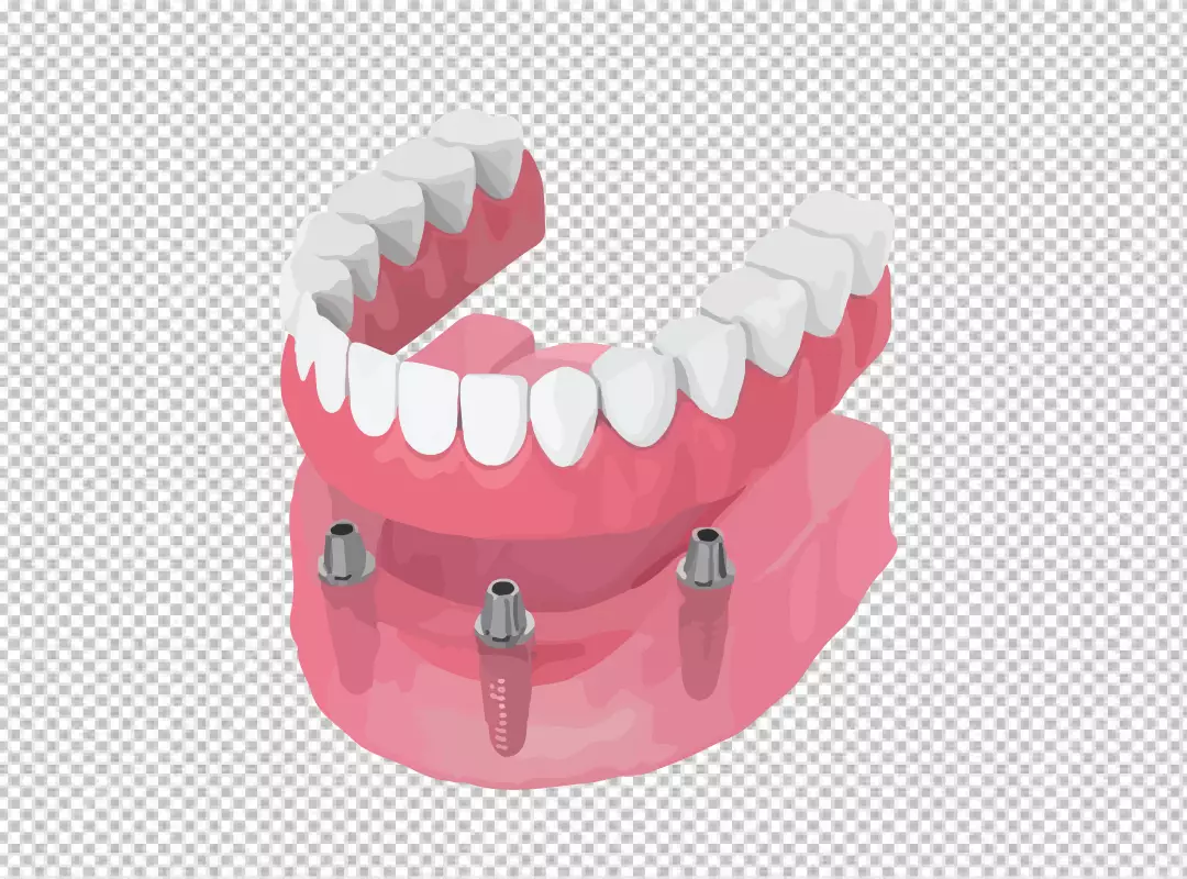 Detailed Dental Implant Model for Full Arch Tooth Replacement and Oral Health Education