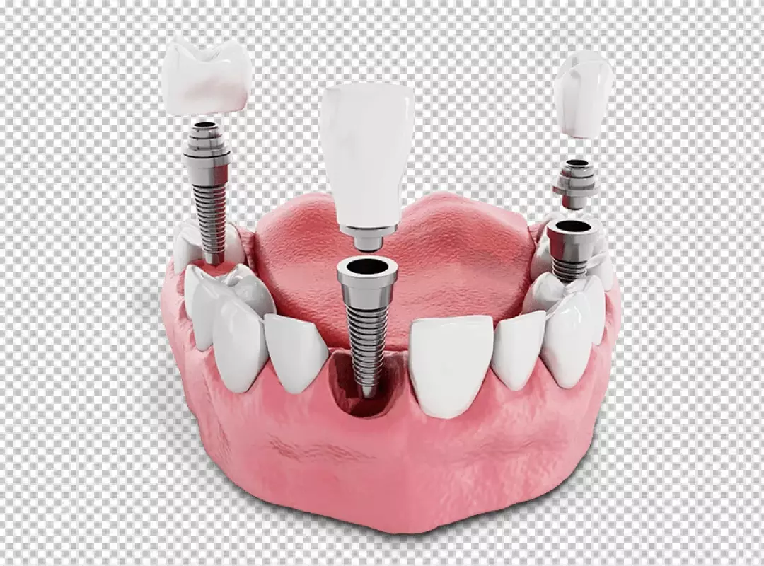 Detailed 3D Dental Implant Illustration Showing Jawbone, Abutment, and Crown Components