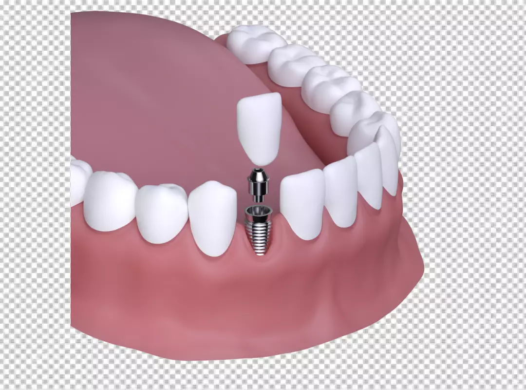 3D Rendering of Dental Implant Components for Comprehensive Tooth Replacement