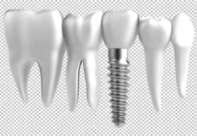 a dental implant screw-shaped device that is surgically implanted into the jawbone to replace a missing tooth