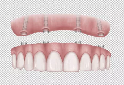 Illustration of All-on-4 Dental Implants Supporting a Full Arch Prosthetic Denture image