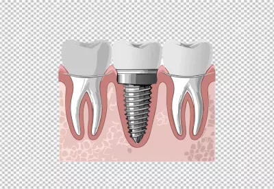 Illustrative Diagram of Modern Dental Implant and Adjacent Healthy Teeth image