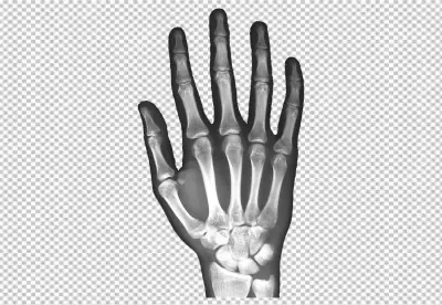 X-ray of a Human Hand