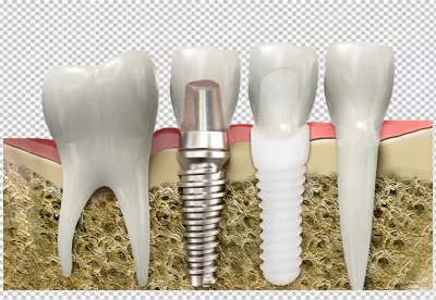 Comparative Anatomy of Natural Teeth and Modern Dental Implants in Jawbone image