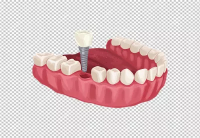 Dental Implant Illustration Showing Tooth Replacement in Jawbone for Oral Health image