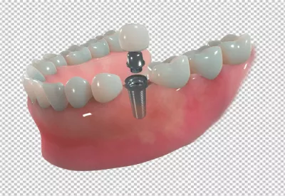 Step-by-Step 3D Dental Implant Components for Advanced Tooth Restoration image