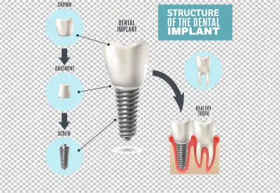 Illustrated Dental Implant Structure and Components for Oral Health Education image