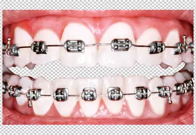 a person's teeth with metal braces