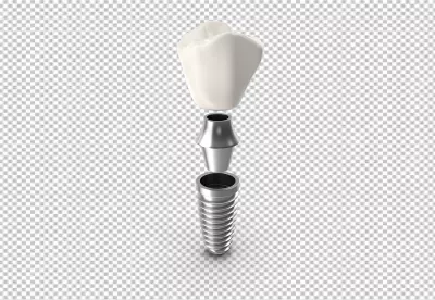 Exploded View 3D Dental Implant Prosthesis Components image