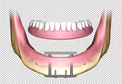 3D Rendering of All-on-4 Dental Implants Supporting a Full Arch Prosthesis image