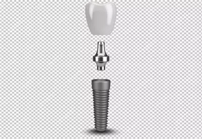 Disassembled Dental Implant System Showing Crown, Abutment, and Screw on Black image