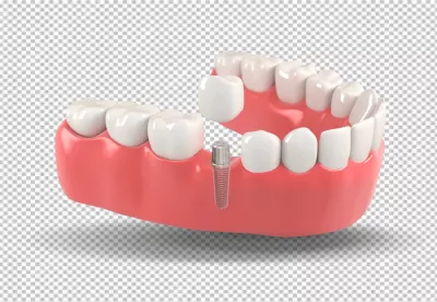3D Model of Dental Implant: Jaw, Abutment, and Crown Components image