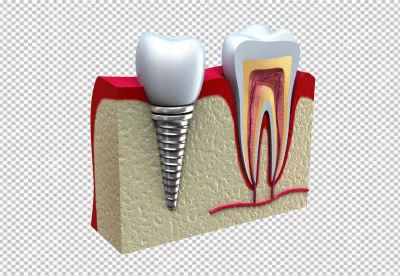 Comparative View of Dental Implant and Human Tooth Anatomy image