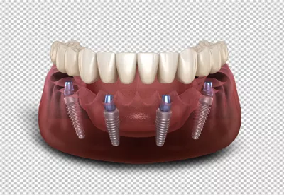 3D Rendering of All-on-4 Dental Implants in Human Lower Jaw image