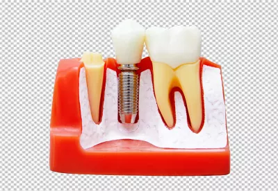 Detailed Dental Implant Model Illustrating Prosthetic Tooth Placement for Oral Health image