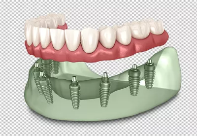 Advanced 3D Dental Model Showing Full Arch Restoration with Implants image