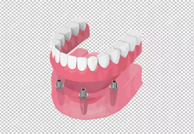 Detailed Dental Implant Model for Full Arch Tooth Replacement and Oral Health Education image
