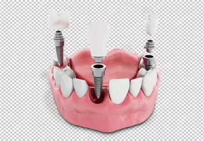 Detailed 3D Dental Implant Illustration Showing Jawbone, Abutment, and Crown Components image