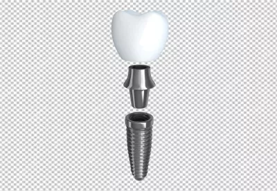 Three-Part Dental Implant System Components Disassembled for Clear Medical Education image