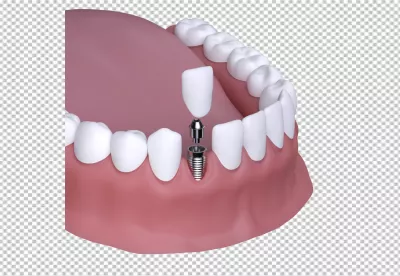 3D Rendering of Dental Implant Components for Comprehensive Tooth Replacement image